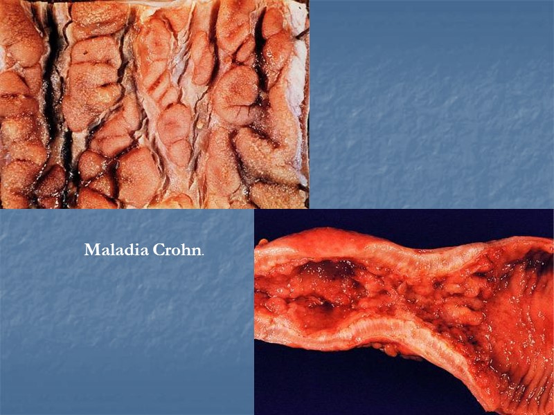 Maladia Crohn.